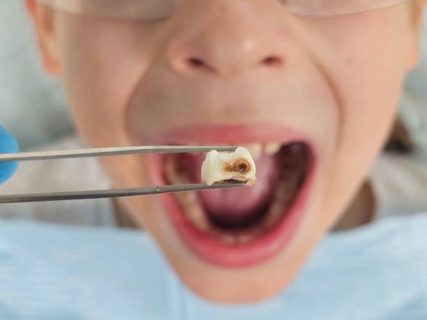 Best Emergency Treatment for Toothache in Edmonston, MD